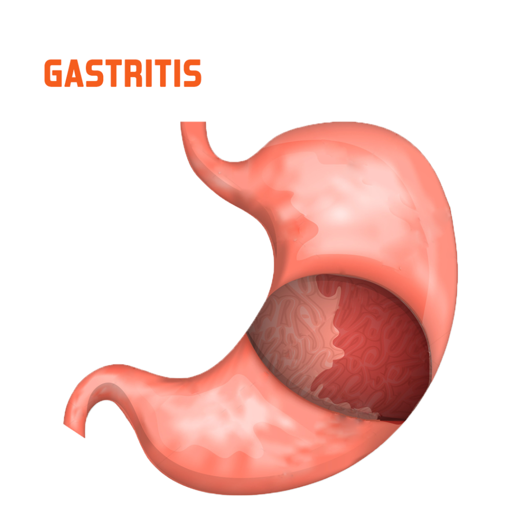 gastritis disease photo