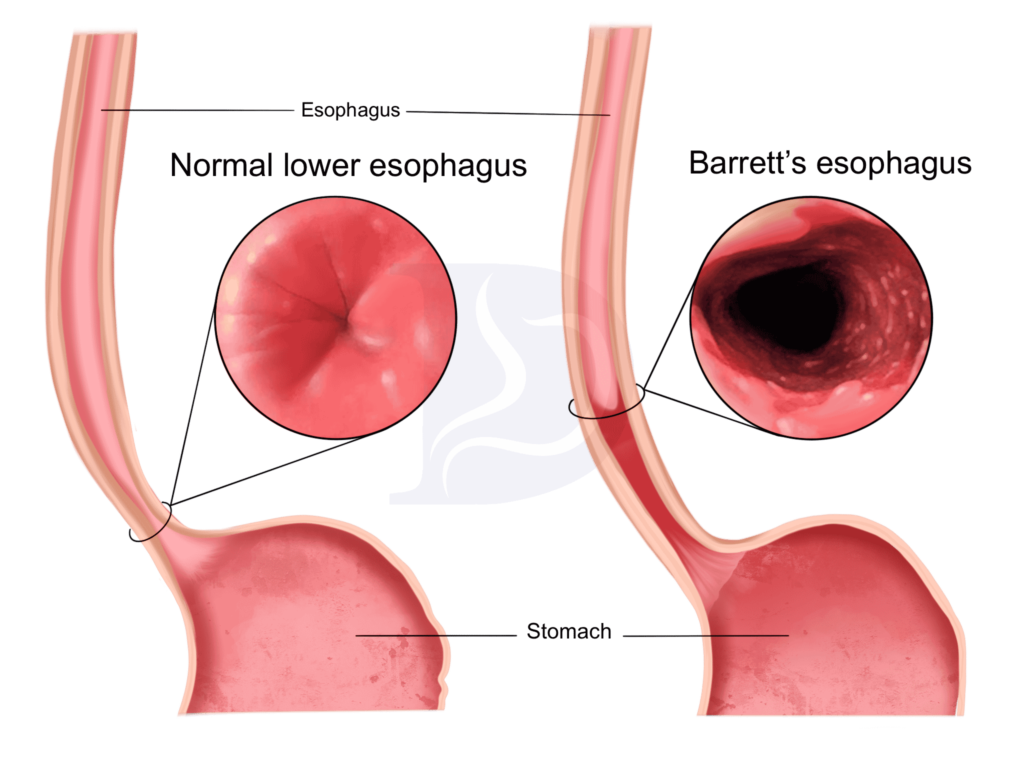 Barrett's Esophagus