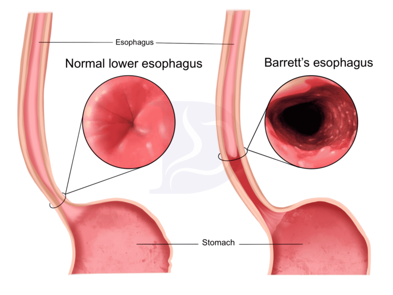 Barrett's Esophagus