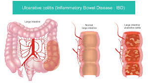 Ulcerative colitis